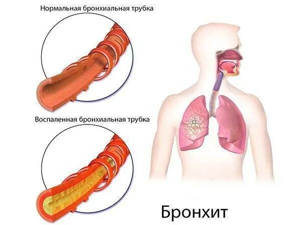 Почему в горле скапливается мокрота