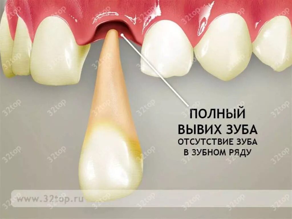 альвеолит стоматология. остановка кровотечения из лунки зуба. травматическая экстракция зуба. острая травма зуба классификация. травматическая экстракция зуба.