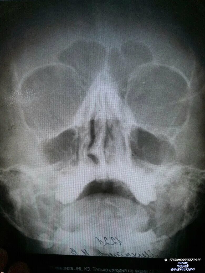Удаление гребня. Шип носовой перегородки рентген. Искривленная носовая перегородка рентген. Рентген пазух носа искривление перегородки. Кривая носовая перегородка на кт.