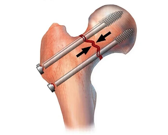 Остеосинтез перелома бедренной кости. Остеосинтез перелома шейки бедра канюлированными винтами. Перелом шейки бедра остеосинтез. Остеосинтез шейки бедренной кости винтами. Остеосинтез операция пластины