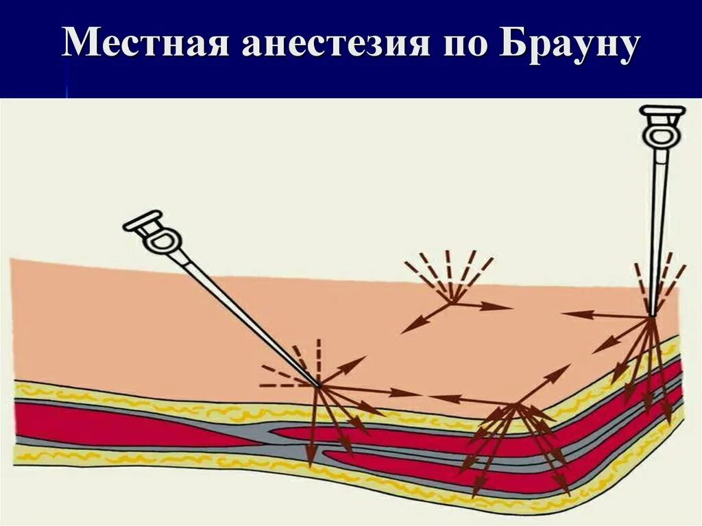 Местная анестезия. Обезболивание местной анестезии. Местная анестезия презентация. Местная инфильтрационная анестезия по Брауну. Поверхностная местная анестезия