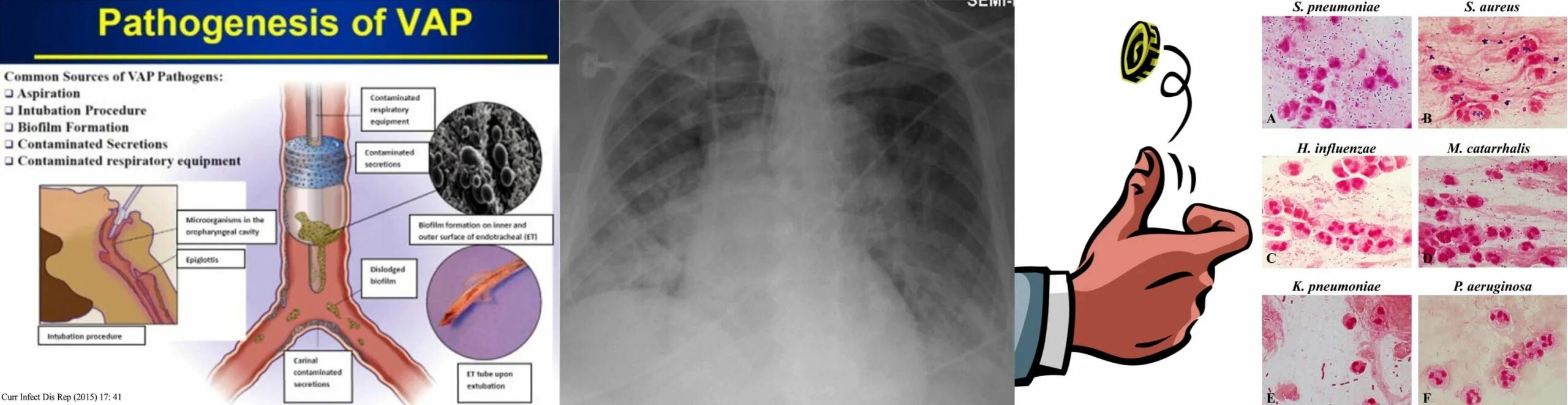 Ventilator-associated pneumonia (Vap). Ventilator-associated (Vap). Вейп-ассоциированные пневмонии. Вентилятор ассоциированные пневмонии. Vap tpu ru