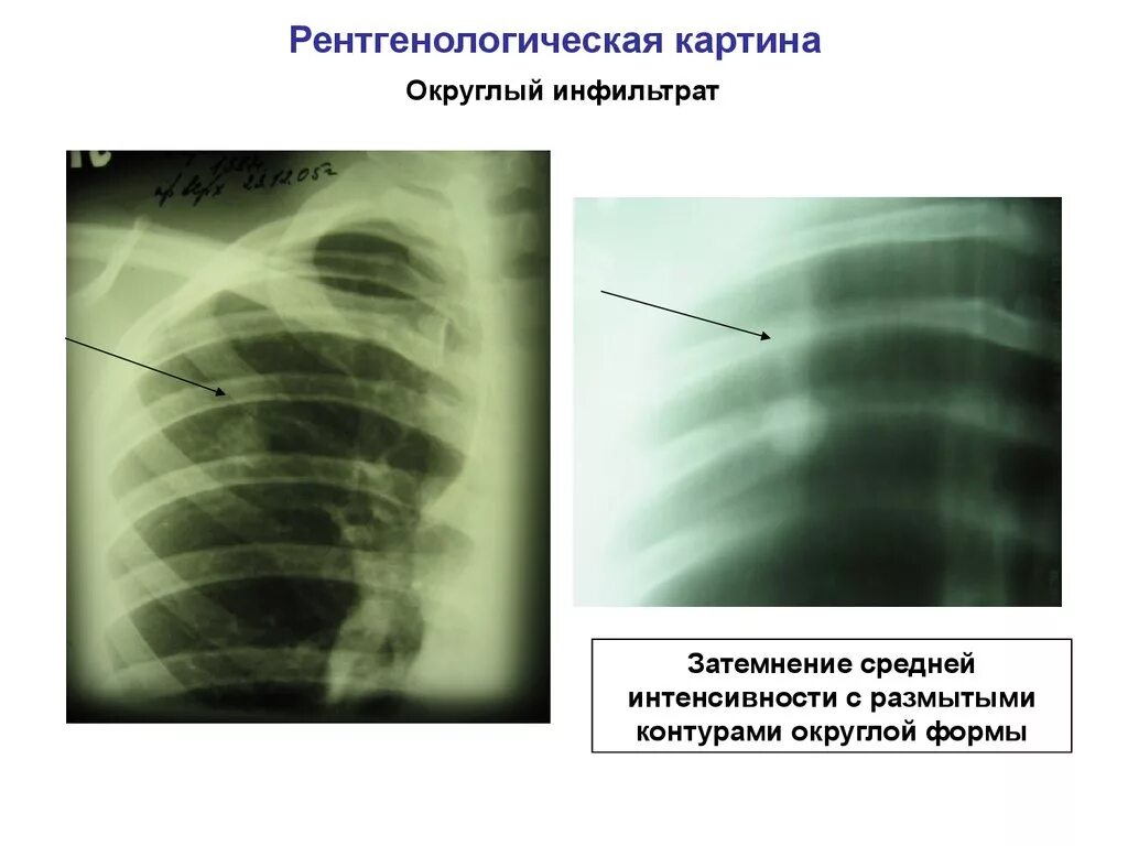 Округлый инфильтрат