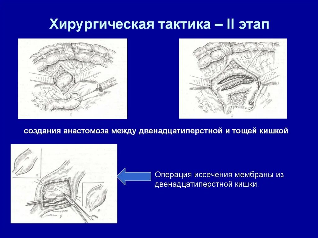 Симптомы операция кишечнике. Кишечная непроходимость операция. Классификация непроходимости кишечника. Этапы операции кишечной непроходимости. Этапы операции при кишечной непроходимости.