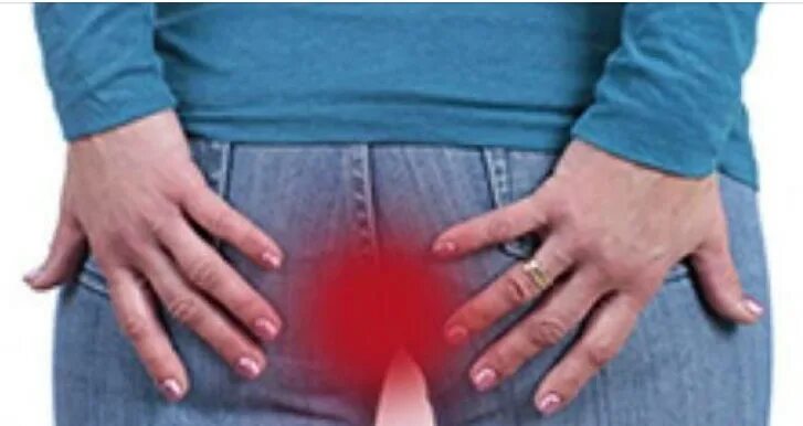 Зудит и чешется в заднем проходе у женщин. Зудит и чешется в заднем проходе у женщин причины. Перианальный дерматит. Зуд у женщин в заднем. Сильный зуд в заднем проходе у женщин причины.