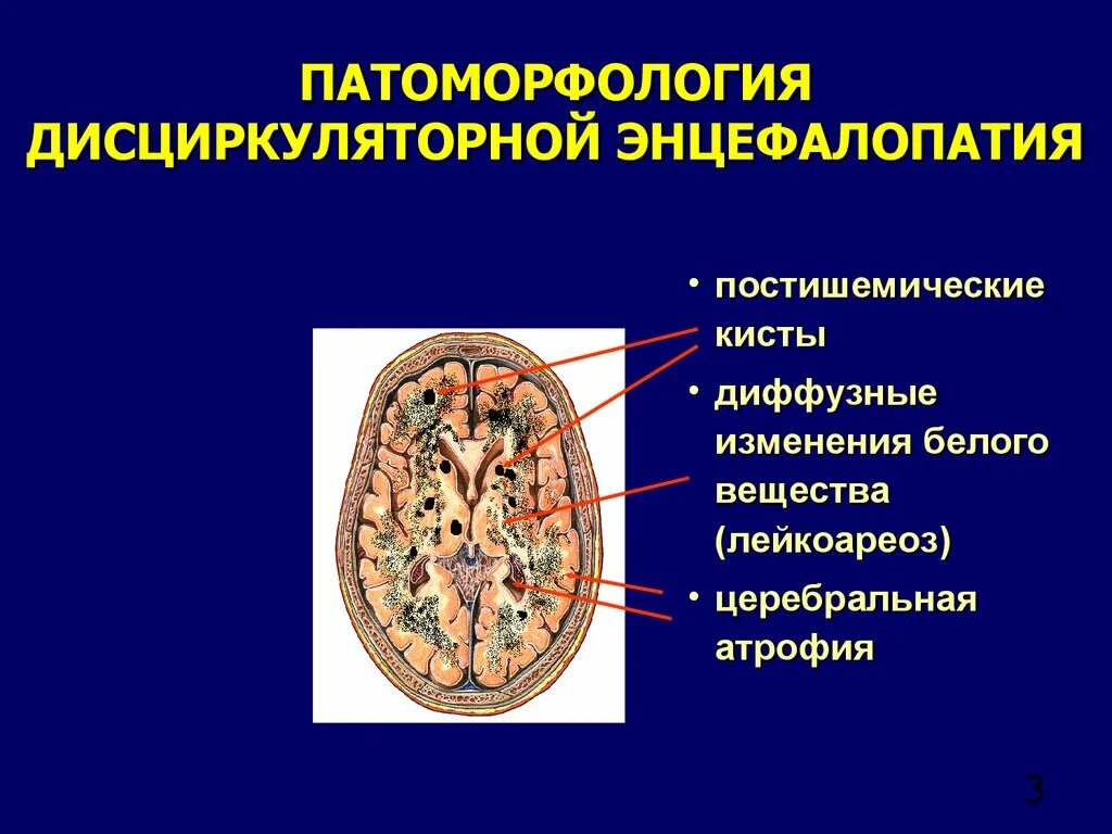 Инцефалпатия головного могза. Дисциркуляторная энцелофапатия. Дисциркуляторной энцефалопатии. Постишемические изменения мозга