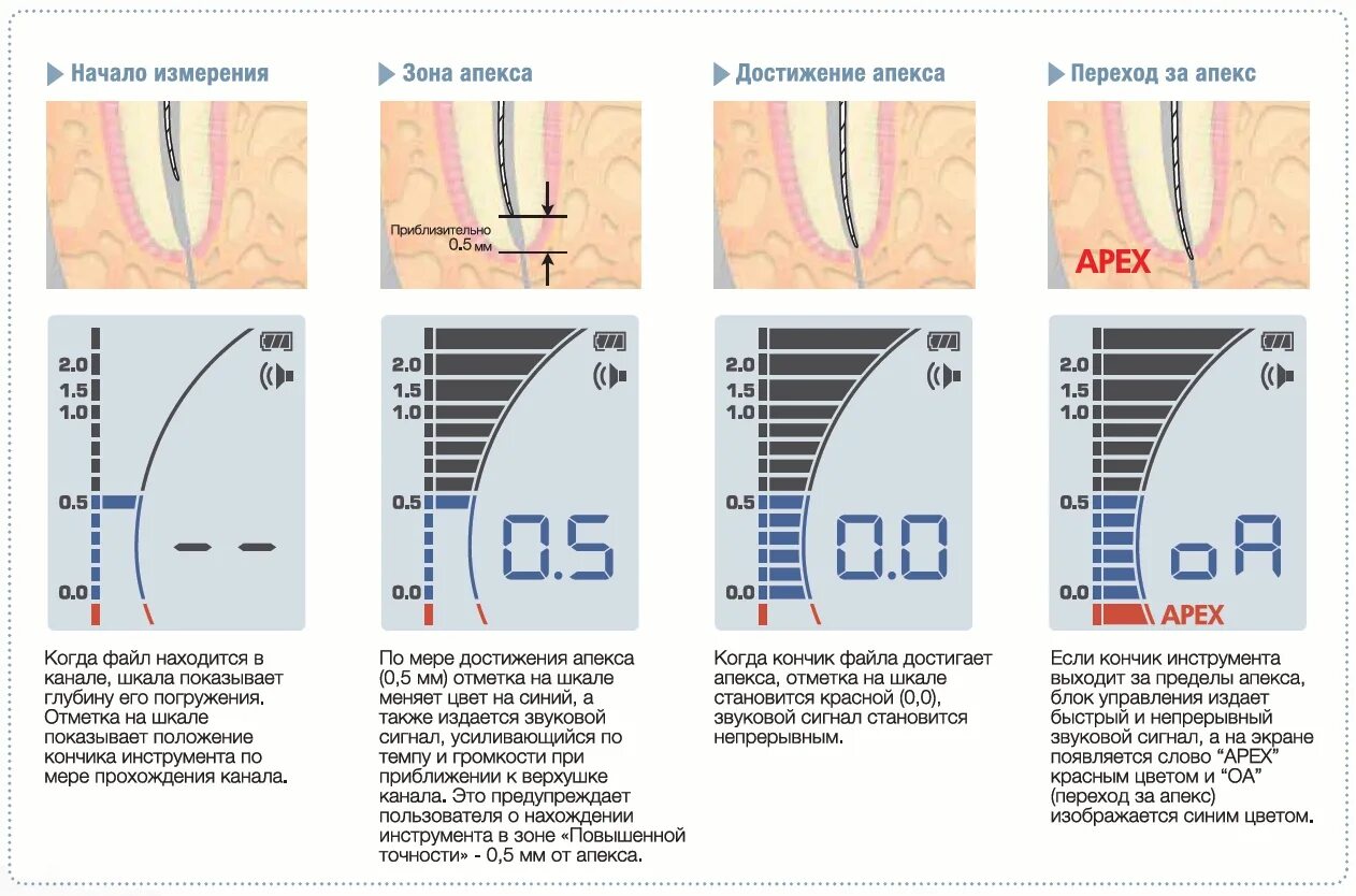 Определение корневых каналов. Апекслокатор IPEX II NSK. Измерение длины канала апекслокатором. Рабочая длина корневого канала методы. Измерения корневого канала прибор.