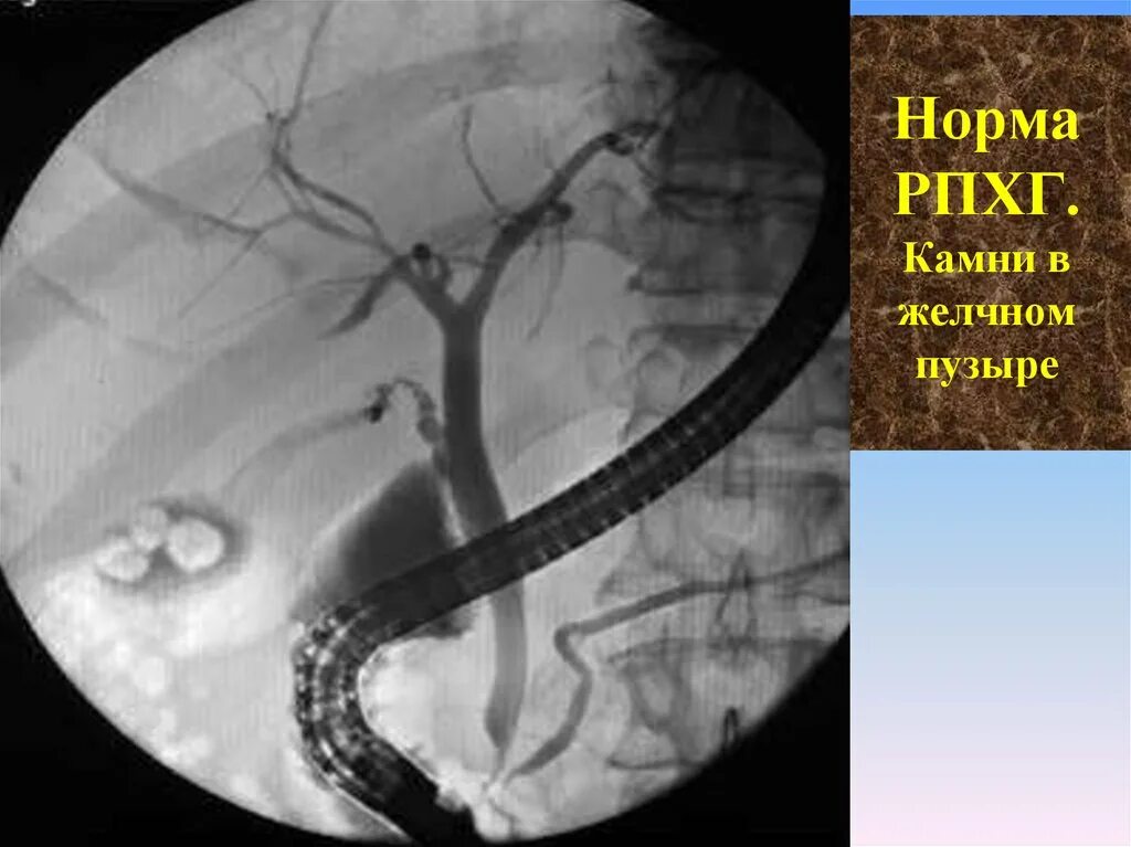 ЭРХПГ поджелудочной железы. Холангиопанкреатография ретроградная холангиопанкреатография. Эндоскопическая ретроградная панкреатография. Холангиопанкреатография поджелудочной железы. Стент желчного протока