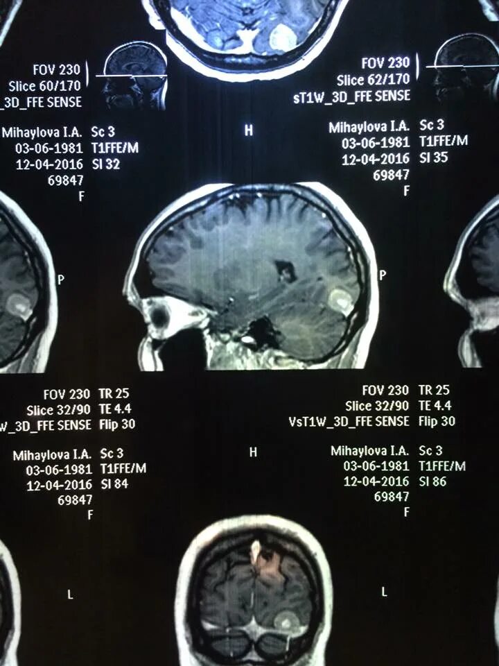 Опухоль мозга у собак. Анализы на опухоль мозга. Мрт головного мозга при опухоли.