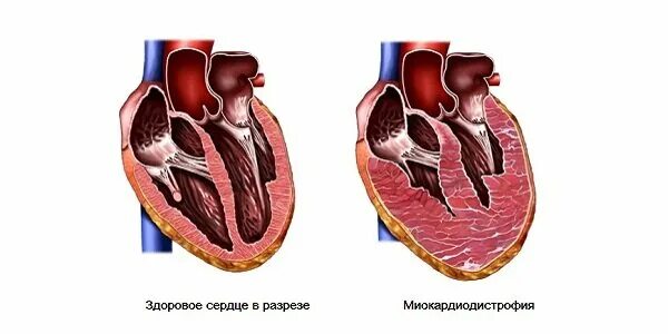 Повреждение миокарда сердца. Рестриктивная миокардиодистрофия. миокардит сердца животных. гипертрофия миокардит. миокардиты -мышца сердца.