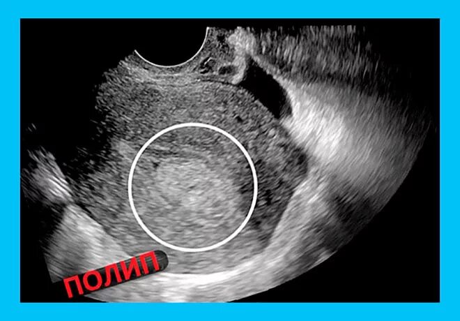 При полипе можно забеременеть. Полип и беременность на УЗИ.
