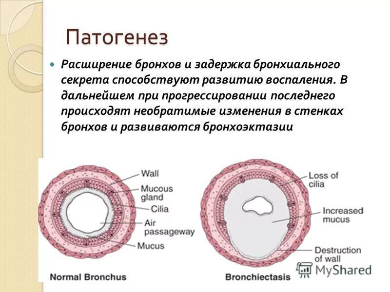 Расширение бронхов. Патогенез бронхоэктатической бронх.