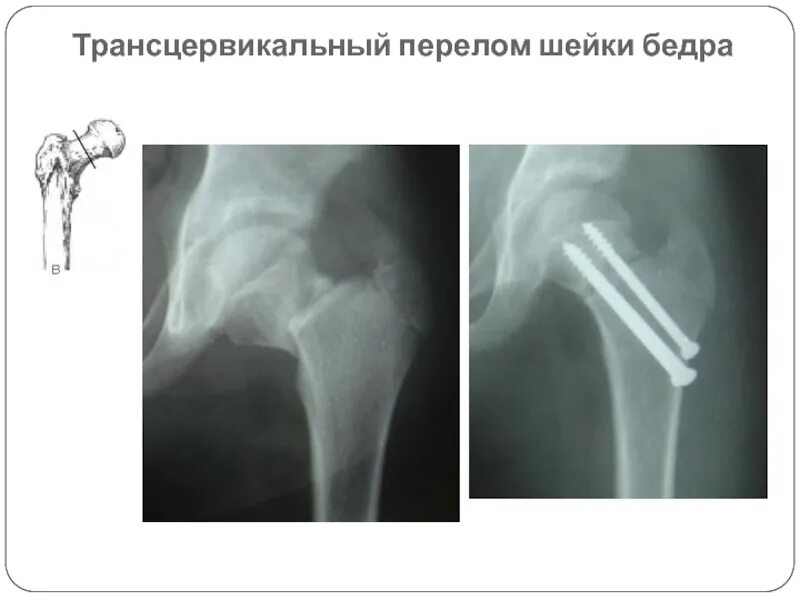 Перелом шейки бедра остеосинтез. Трансцервикальный перелом шейки бедра рентген. Переломы шейки бедра классификация рентген. Субкапитальный перелом бедра. Шейки левого бедра