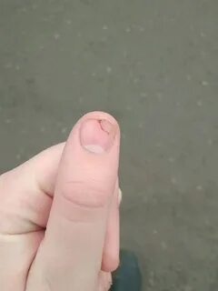 Бугорки на ногте большого пальца