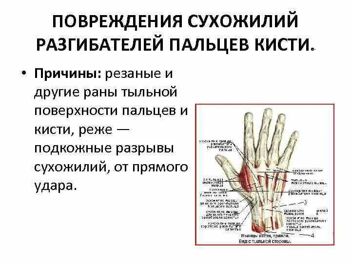 Симптом повреждения сухожилия лучезапястного сустава. Зоны повреждения разгибателей кисти. Повреждение сухожилия разгибателя 1 пальца кисти. Основной признак повреждения сухожилия сгибателя пальца:.