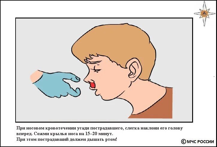 Как укрепить нос при кровотечении. Носовое кровотечение оказание первой помощи. оказание первой помощи при носовом кровотечении. пмп при кровотечении из носа.