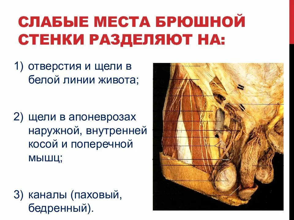 Стенка анатомия. Слабые места брюшной стенки. Слабые места брюшной стенки мышцы анатомия. Слабые места брюшной стенки топографическая анатомия. Слабые места живота анатомия.