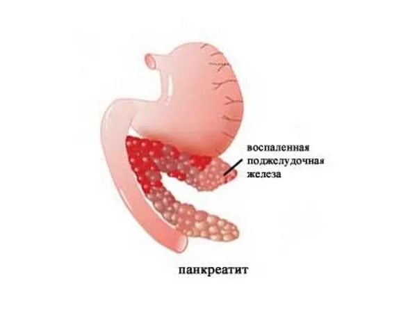 Симптомы острого панкреатита поджелудочной. Обтурация протока поджелудочной железы. Симптомы загиба поджелудочной железы. Внутреннее строение поджелудочной железы. Симптомы загиба поджелудочной железы.