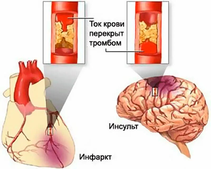 Атеросклероз инфаркт. Инсульт и инфаркт. атеросклероз инсульт инфаркт. что такое инсульт и что такое инфаркт миокарда. инфаркт инсульт сердечный приступ.