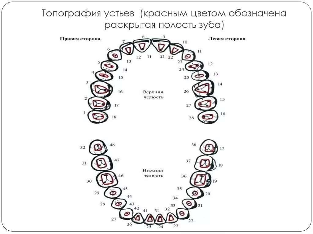 Топография устьев корневых каналов 36 зуба. Схема каналов зубов верхней челюсти. Топография корневых каналов 16 зуба. Расположение устьев корневых каналов в 26 зубе. Каналы верхней 6