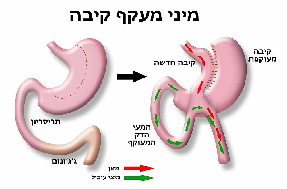 Резекция желудка анемия. Желудочное шунтирование (gastric Bypass). Желудочное шунтирование схема операции. Мини шунтирование желудка. Шунтирование желудка схема.