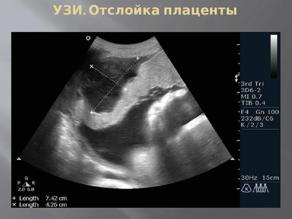 Ретрохориальная гематома снимок УЗИ. Преждевременная отслойка нормально расположенной плаценты УЗИ. Преждевременная отслойка плаценты УЗИ. 13 неделе беременности плацента