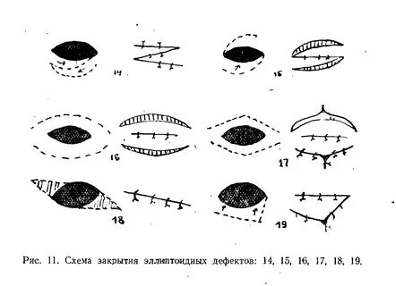 Местная пластика