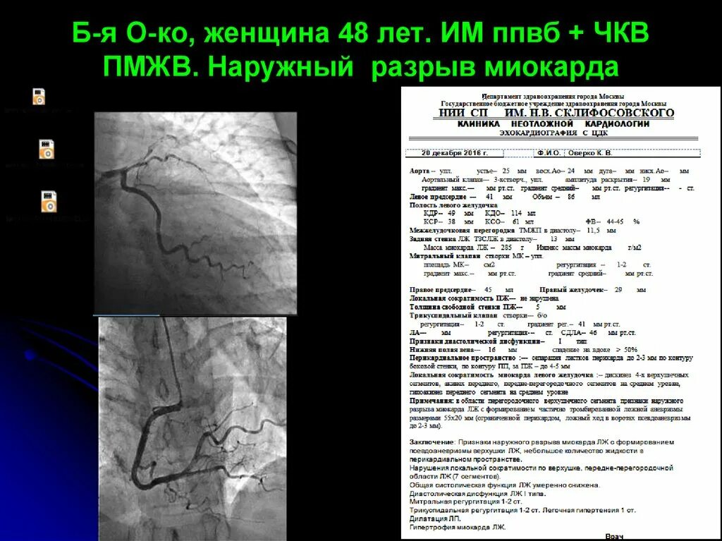 Наружный разрыв. ЧКВ. Стентирование ПМЖВ. Чрескожное коронарное вмешательство при инфаркте. ЧКВ при инфаркте миокарда.