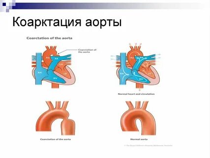 Гемодинамика коарктация