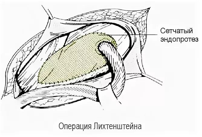 Паховая герниопластика