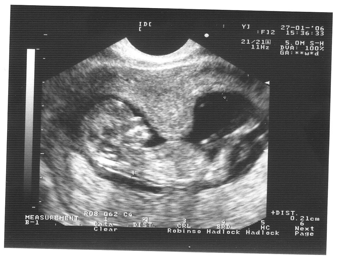 Гипертонус матки при беременности 2 триместр УЗИ. Тонус матки при беременности 1 триместр УЗИ. Гипертонус стенки матки при беременности 12 недель. Гипертонус матки на УЗИ при беременности. Шейка в 12 недель