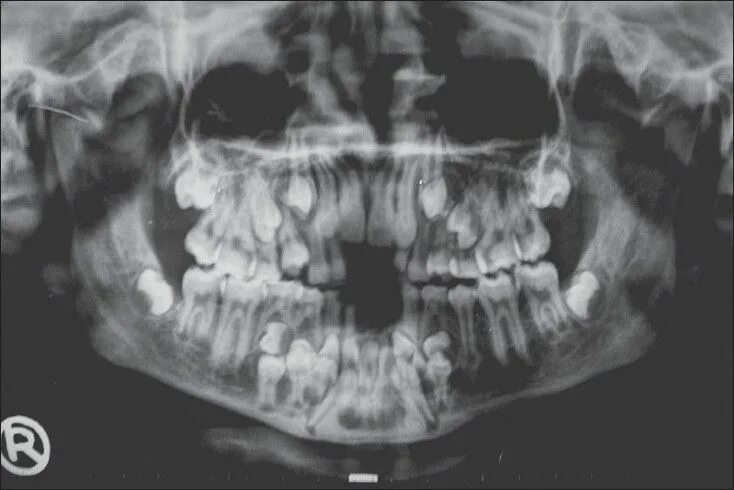 Полиодонтия\ гипердонтия. Гипердонтия зубов рентген. Детский череп рентген