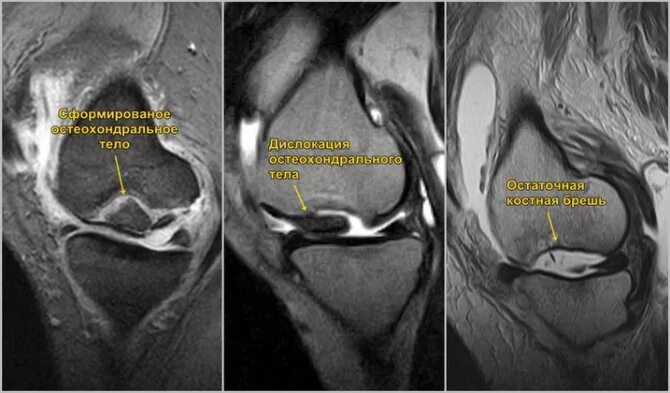 Некроз мыщелки. Остеохондральное повреждение коленного сустава мрт. Остеохондропатия коленного сустава мрт. Болезнь Кёнига рассекающий остеохондрит мрт. Хондромаляция надколенника Outerbridge.