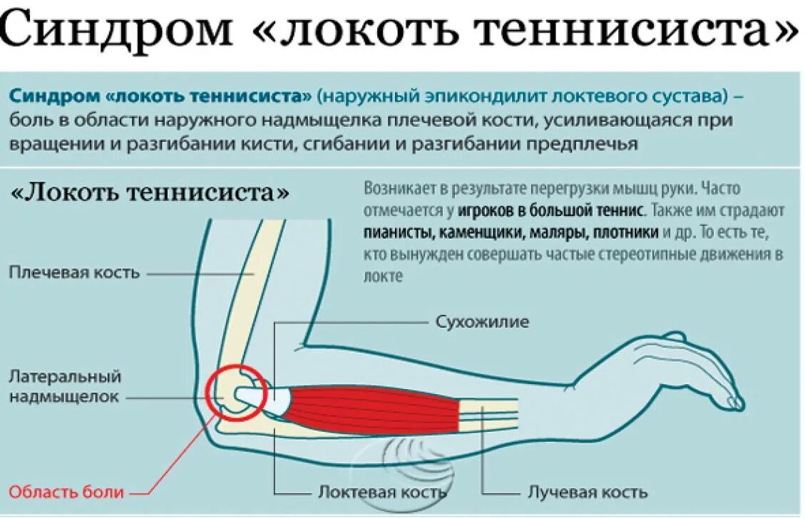 Лечение предплечья. Наружный эпикондилит локтевого сустава симптомы. Локоть теннисиста эпикондилит. Латеральный надмыщелок локтевого сустава. Синдром локоть теннисиста.