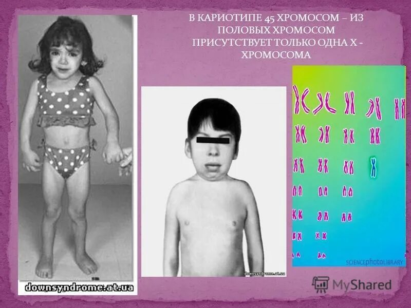 50 chromosome. 45 Хромосом у человека болезнь. Человек без одной хромосомы.