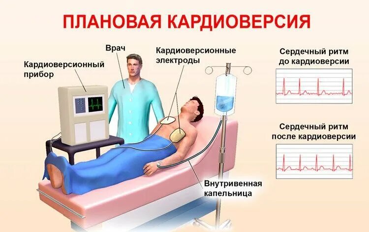 Фибрилляция дефибриллятор. Трансвенозная кардиоверсия. электрическая кардиоверсия (дефибрилляция). кардиоверсия и электроимпульсная терапия. эит и электрическая кардиоверсия.