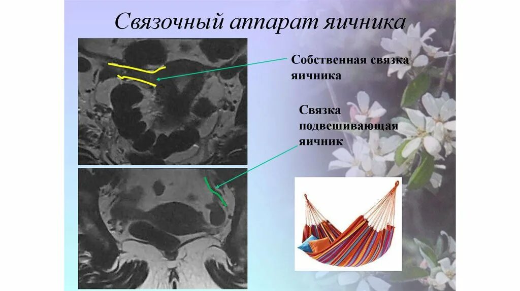 Связочный аппарат яичника. Собственная связка яичника анатомия. Связка подвешивающая яичник анатомия. Подвешивающаяся связка яичника.