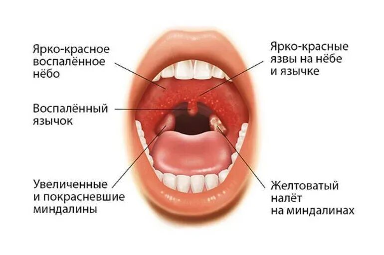 Горло сильно болит чем лечить у взрослого. Инфекционный мононуклеоз ангина. Энтеровирус герпангина.