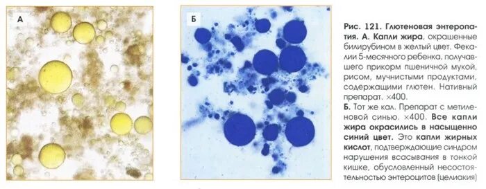 Жирные кислоты в большом количестве в кале. Нейтральный жир в Кале микроскопия. Внеклеточный крахмал в микроскопии кала. Копрограмма нейтральный жир. Микроскопия кала жирные кислоты.