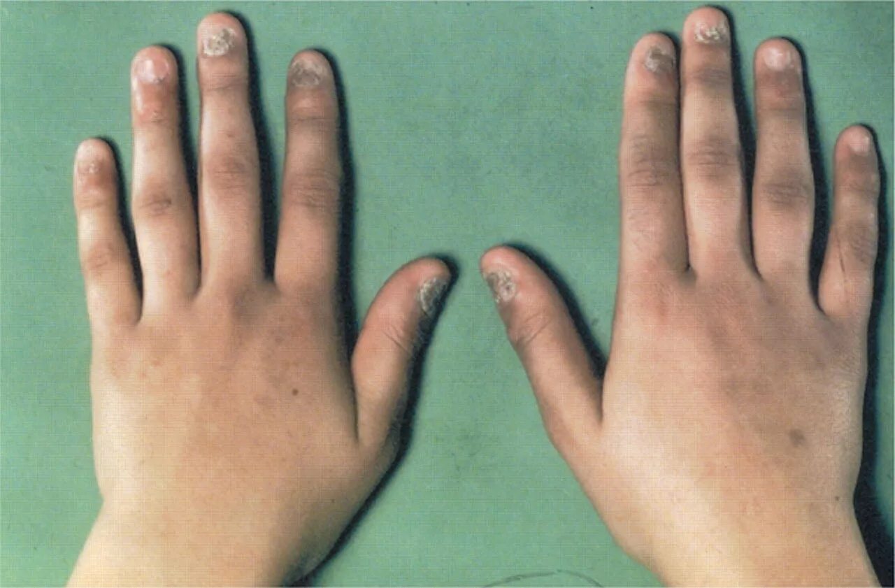 Почему пальцы темные. Надпочечниковая недостаточность болезнь Аддисона. Хроническая надпочечниковая недостаточность (болезнь Аддисона). Болезнь Аддисона надпочечники.