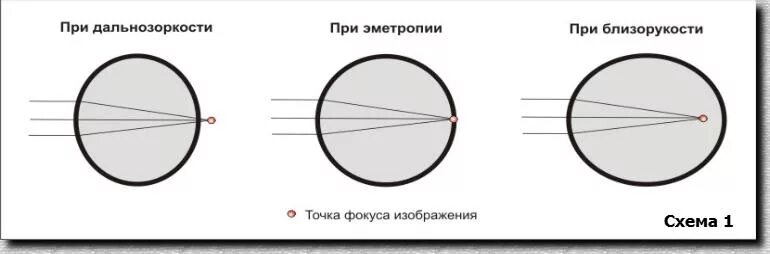 При дальнозоркости изображение формируется