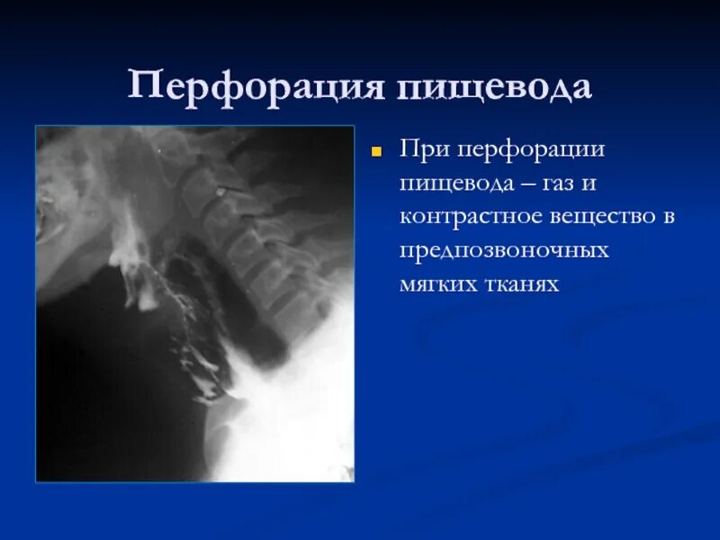 Газы в пищеводе