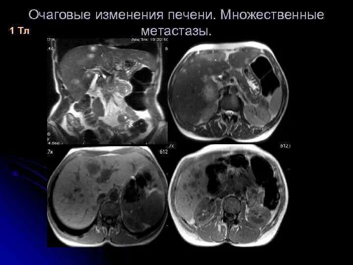 Множественные образования в печени. Очаговые поражения печени. Очаговые изменения паренхимы печени. Очаговые образования печени кт. Диффузные поражения печени на кт.