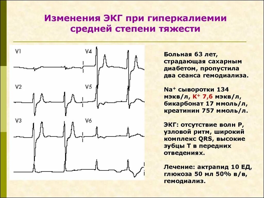 Изменения на ЭКГ при гиперкалиемии. Гиперкалиемия клиника. Гипокалиемия и гиперкалиемия на ЭКГ. Гиперкалиемия симптомы ЭКГ.