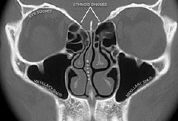 Воспаление решетчатой пазухи на рентгене. Гайморит верхнечелюстной пазухи кт. Хронический сфеноидит на кт. Локальное утолщение слизистой