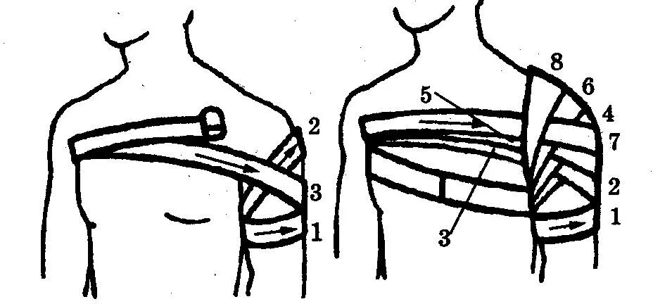 Плечевая повязка алгоритм. Наложение колосовидной повязки на плечевой сустав. Колосовидная повязка на плечо алгоритм. Техника наложения колосовидной повязки на плечо. Колосовидная повязка на плечевой сустав алгоритм.