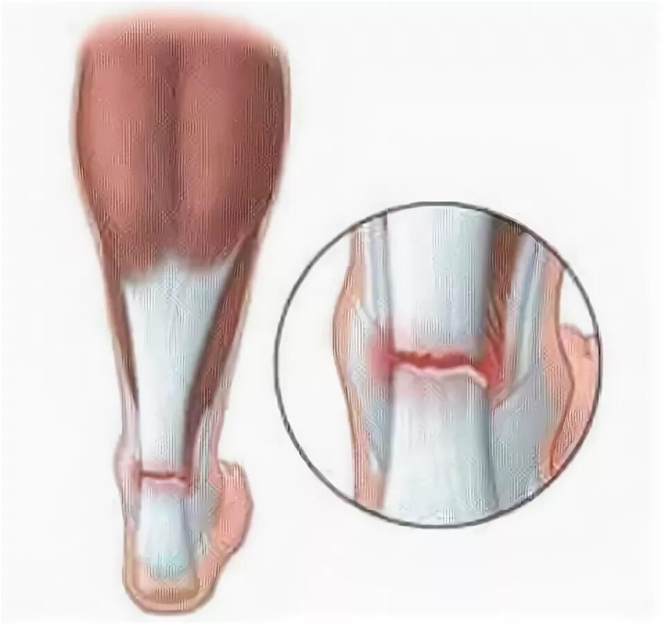 Разрыв ахиллова сухожилия. Ахиллесово сухожилие повреждение. Растяжение ахиллесова сухожилия. Растяжение ахиллова сухожилия. Ахиллово сухожилие разрыв ахиллова сухожилия
