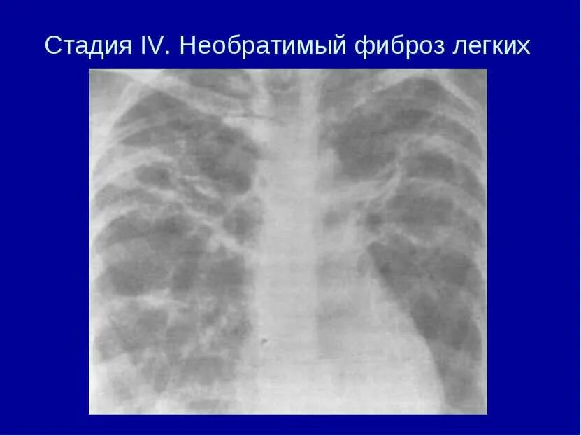 Легкие фиброзного характера. Фиброзные тяжи в легких рентген. Fibroz lyogkix.