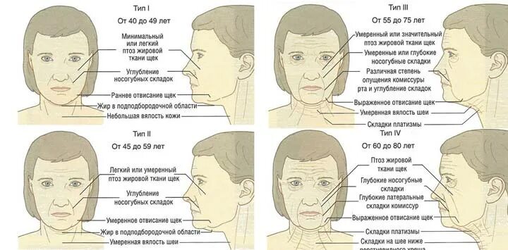 Гравитационный птоз лица. Классификация птоза лица. Птоз век классификация.