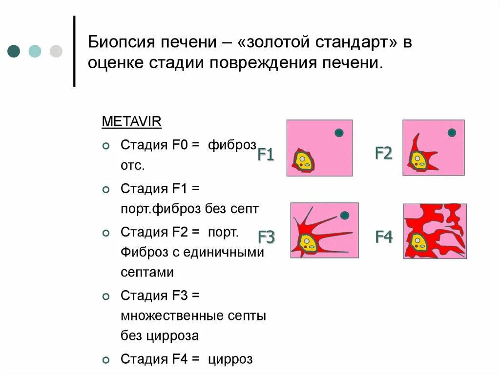 Стадии повреждения печени. Биопсия печени золотой стандарт. Стадия фиброза metavir.